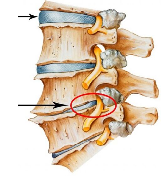 servikal osteokondroz