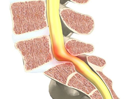 Osteokondroz üçün qan motor seqmenti
