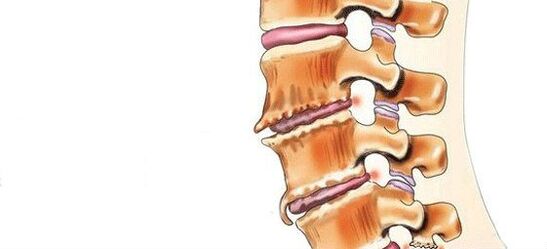 Spondiloz - intervertebral birləşmələrin məhv edilməsi