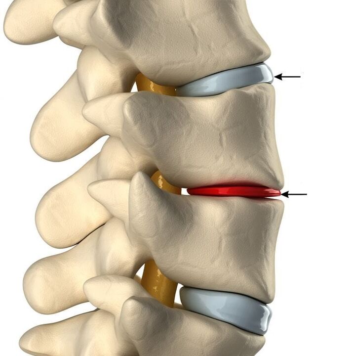 Sağlam disk və osteokondroz olan bir disk arasındakı fərq
