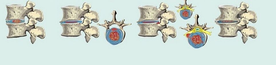 Torakik osteokondrozun müxtəlif mərhələləri