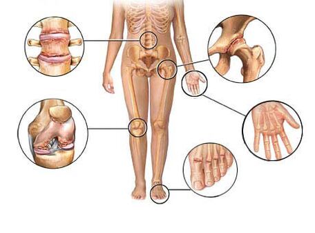 Arthroz müxtəlif oynaqlara təsir göstərir