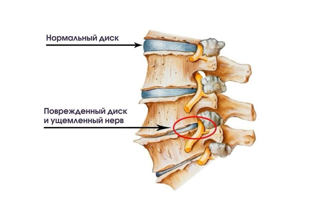 Servikal osteokondrozun simptomları
