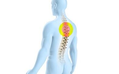 torakal onurğanın osteoxondrozu