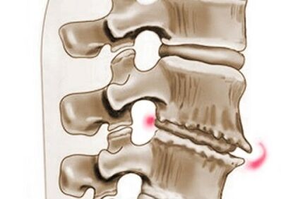 torakal osteokondrozda vertebraların zədələnməsi